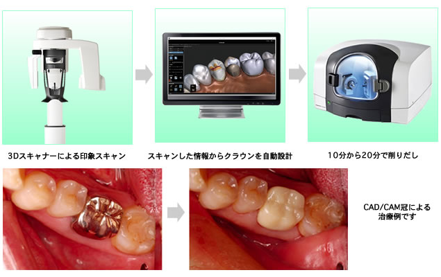 cadcam